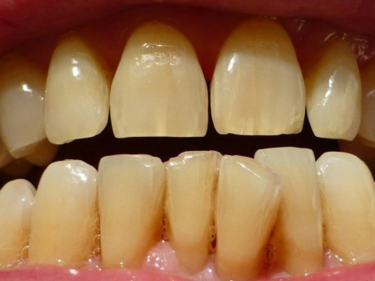 Răng vàng tự nhiên: Yếu tố ảnh hưởng và khi nào cần can thiệp?