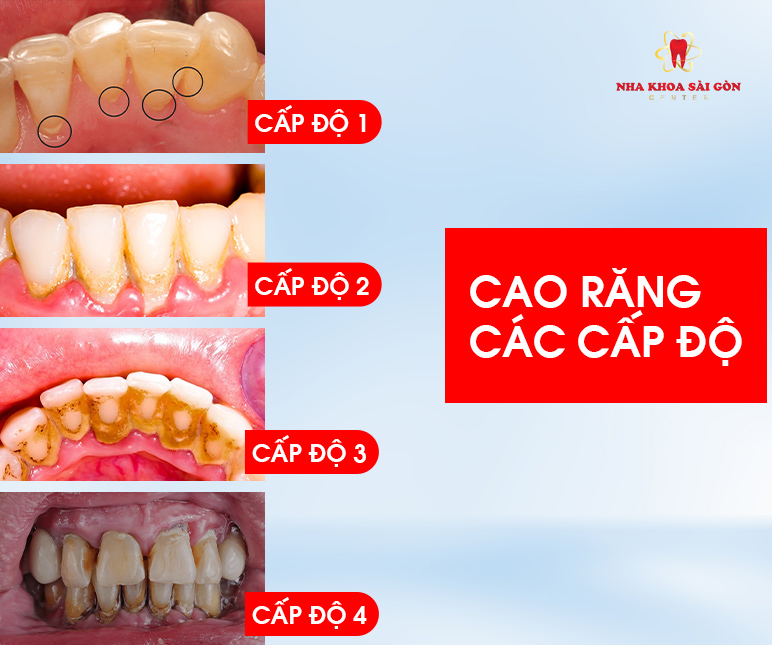 Răng vàng tự nhiên: Yếu tố ảnh hưởng và khi nào cần can thiệp?