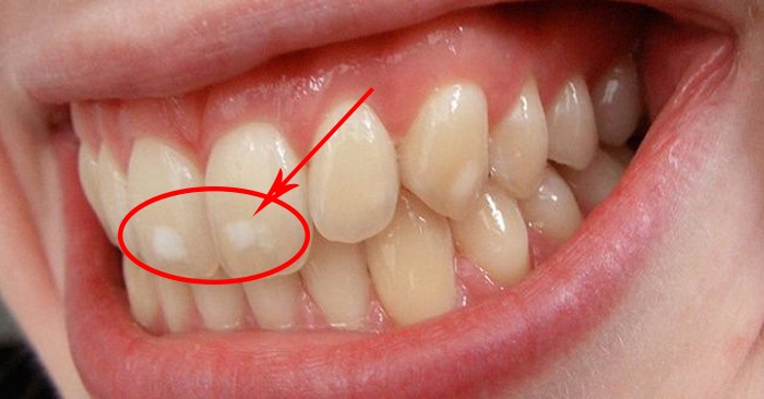 Răng vàng tự nhiên: Yếu tố ảnh hưởng và khi nào cần can thiệp?