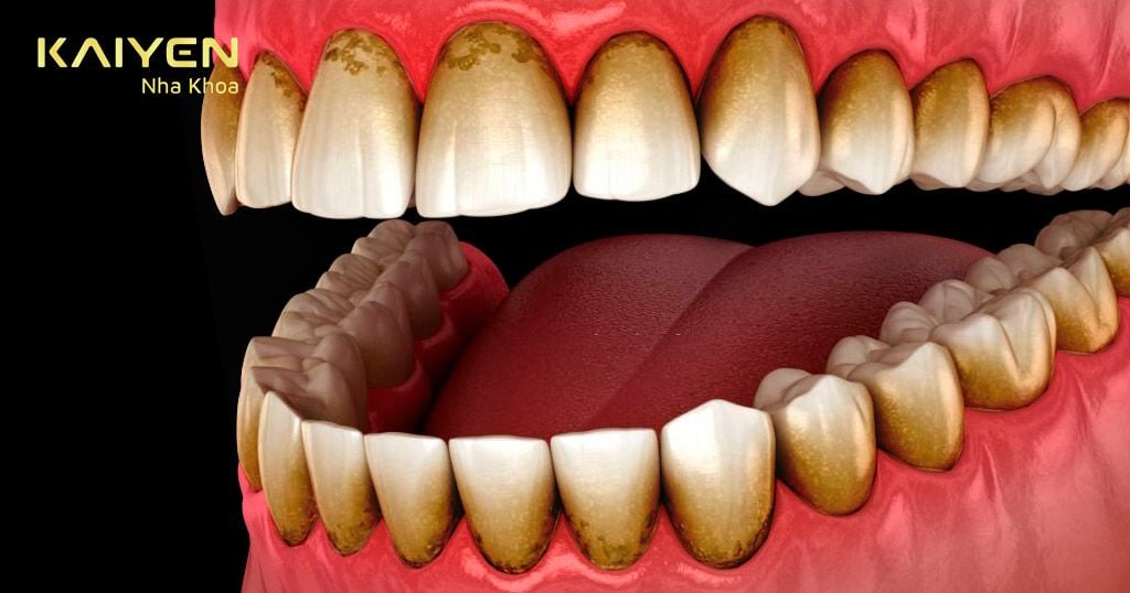 Răng vàng tự nhiên: Yếu tố ảnh hưởng và khi nào cần can thiệp?