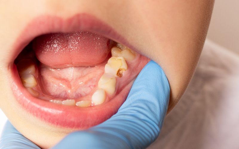 Răng vàng tự nhiên: Yếu tố ảnh hưởng và khi nào cần can thiệp?