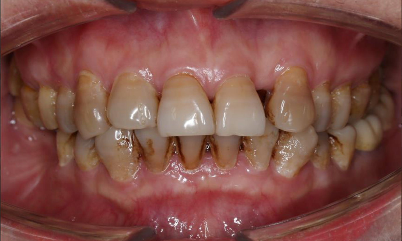 Răng vàng tự nhiên: Yếu tố ảnh hưởng và khi nào cần can thiệp?