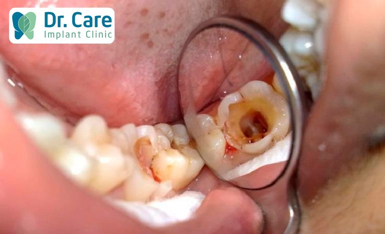 Răng vàng tự nhiên: Yếu tố ảnh hưởng và khi nào cần can thiệp?