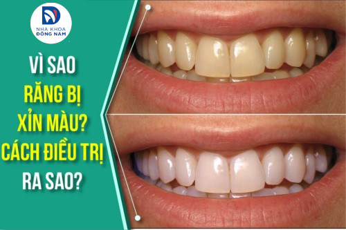 Răng vàng tự nhiên: Yếu tố ảnh hưởng và khi nào cần can thiệp?