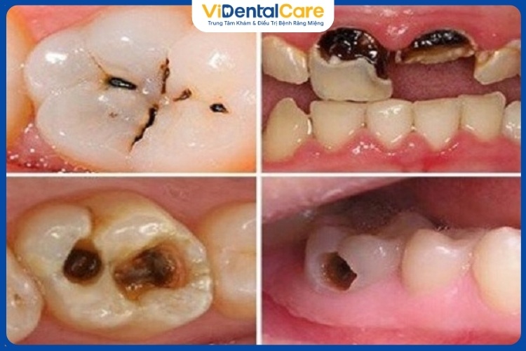 Răng vàng tự nhiên: Yếu tố ảnh hưởng và khi nào cần can thiệp?