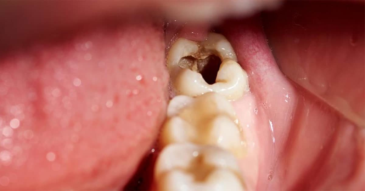 Răng vàng tự nhiên: Yếu tố ảnh hưởng và khi nào cần can thiệp?