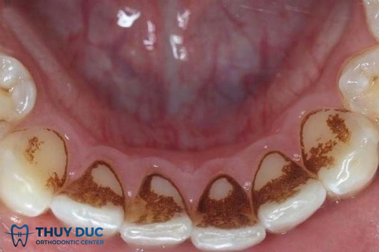 Vàng răng do hút thuốc lá: Tác hại và giải pháp cải thiện Vàng răng do hút thuốc lá: Tác hại và giải pháp cải thiện