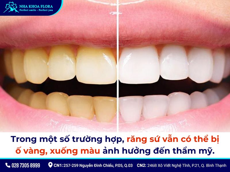 Vàng răng do hút thuốc lá: Tác hại và giải pháp cải thiện Vàng răng do hút thuốc lá: Tác hại và giải pháp cải thiện
