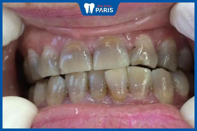 Vàng răng do hút thuốc lá: Tác hại và giải pháp cải thiện Vàng răng do hút thuốc lá: Tác hại và giải pháp cải thiện