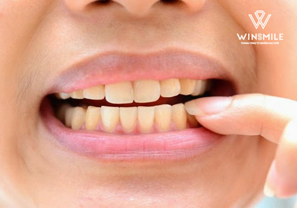 Vàng răng do hút thuốc lá: Tác hại và giải pháp cải thiện Vàng răng do hút thuốc lá: Tác hại và giải pháp cải thiện