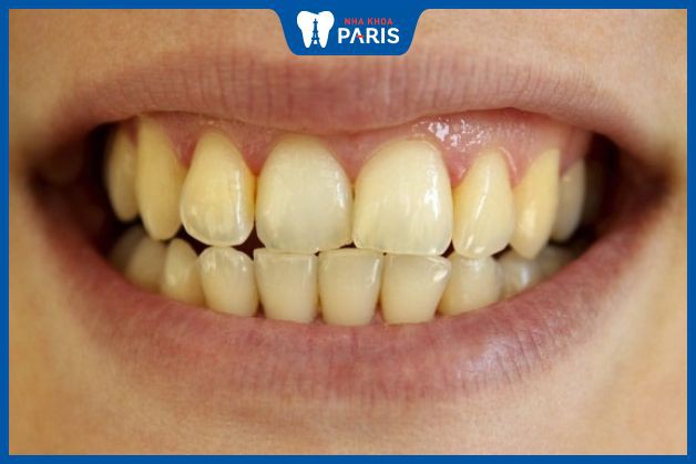 Vàng răng do hút thuốc lá: Tác hại và giải pháp cải thiện Vàng răng do hút thuốc lá: Tác hại và giải pháp cải thiện