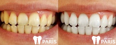Vàng răng do hút thuốc lá: Tác hại và giải pháp cải thiện Vàng răng do hút thuốc lá: Tác hại và giải pháp cải thiện