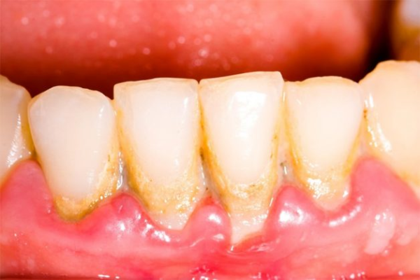 Vàng răng do hút thuốc lá: Tác hại và giải pháp cải thiện Vàng răng do hút thuốc lá: Tác hại và giải pháp cải thiện