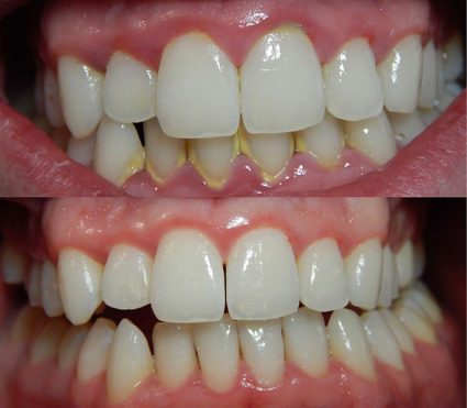 Vàng răng do thói quen uống trà: Ảnh hưởng và lời khuyên nha khoa Vàng răng do thói quen uống trà: Ảnh hưởng và lời khuyên nha khoa