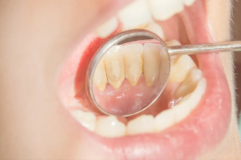Vàng răng do thói quen uống trà: Ảnh hưởng và lời khuyên nha khoa Vàng răng do thói quen uống trà: Ảnh hưởng và lời khuyên nha khoa