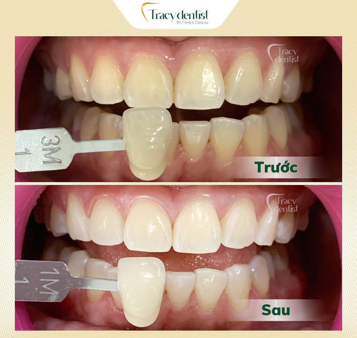 Vàng răng do thói quen uống trà: Ảnh hưởng và lời khuyên nha khoa Vàng răng do thói quen uống trà: Ảnh hưởng và lời khuyên nha khoa