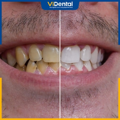 Vàng răng do thói quen uống trà: Ảnh hưởng và lời khuyên nha khoa Vàng răng do thói quen uống trà: Ảnh hưởng và lời khuyên nha khoa