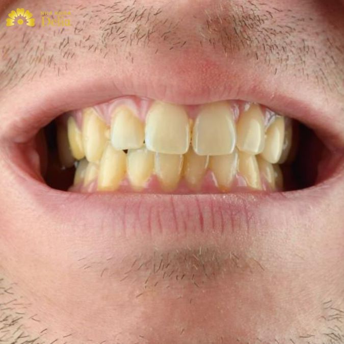 Vàng răng do thói quen uống trà: Ảnh hưởng và lời khuyên nha khoa Vàng răng do thói quen uống trà: Ảnh hưởng và lời khuyên nha khoa