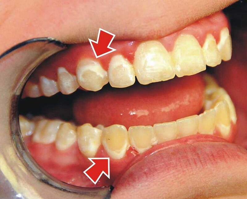 Vàng răng do thói quen uống trà: Ảnh hưởng và lời khuyên nha khoa Vàng răng do thói quen uống trà: Ảnh hưởng và lời khuyên nha khoa