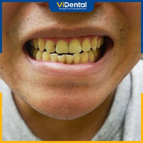 Vàng răng do thói quen uống trà: Ảnh hưởng và lời khuyên nha khoa Vàng răng do thói quen uống trà: Ảnh hưởng và lời khuyên nha khoa