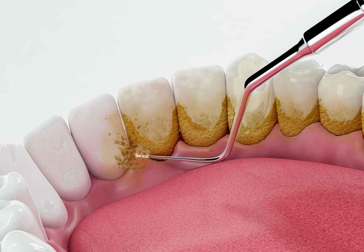 Vàng răng do thói quen uống trà: Ảnh hưởng và lời khuyên nha khoa Vàng răng do thói quen uống trà: Ảnh hưởng và lời khuyên nha khoa