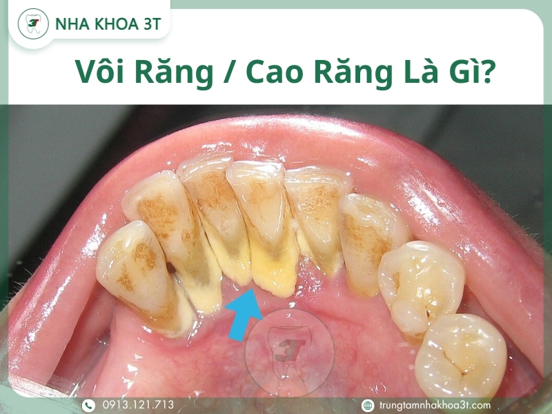 Vàng răng do thói quen uống trà: Ảnh hưởng và lời khuyên nha khoa Vàng răng do thói quen uống trà: Ảnh hưởng và lời khuyên nha khoa