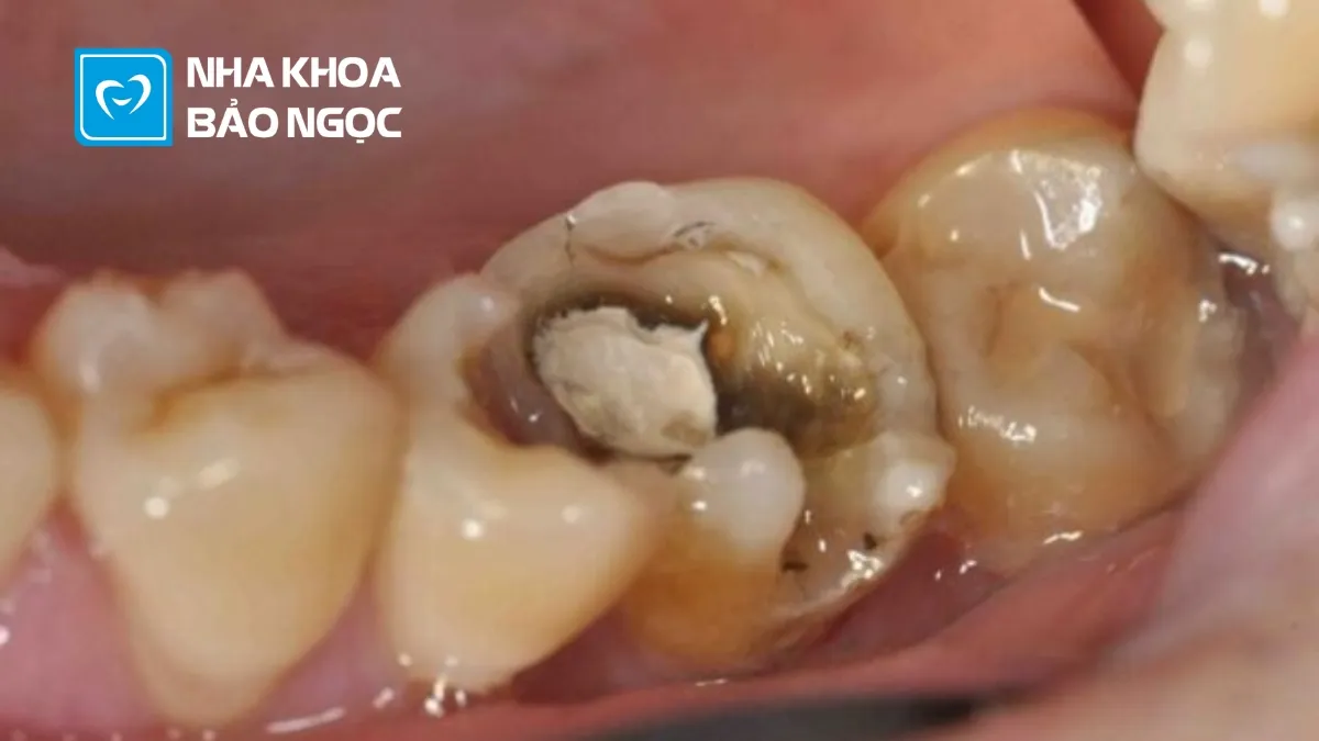 Vàng răng do thói quen uống trà: Ảnh hưởng và lời khuyên nha khoa Vàng răng do thói quen uống trà: Ảnh hưởng và lời khuyên nha khoa