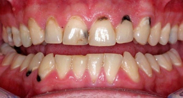 Vàng răng do thói quen uống trà: Ảnh hưởng và lời khuyên nha khoa Vàng răng do thói quen uống trà: Ảnh hưởng và lời khuyên nha khoa