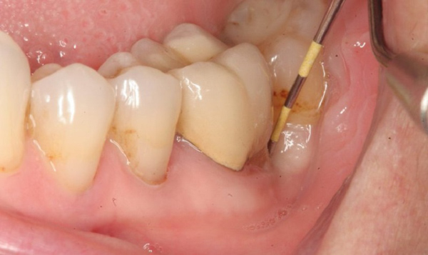 Vàng răng là dấu hiệu của bệnh gì? Chẩn đoán và điều trị Vàng răng là dấu hiệu của bệnh gì? Chẩn đoán và điều trị