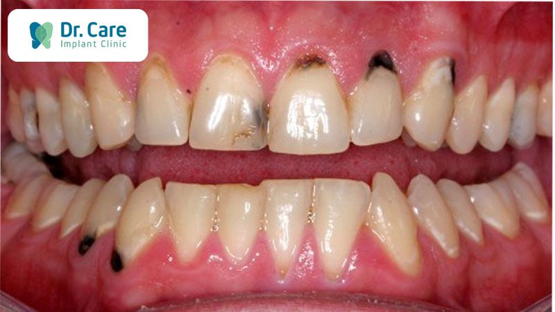 Vàng răng là dấu hiệu của bệnh gì? Chẩn đoán và điều trị Vàng răng là dấu hiệu của bệnh gì? Chẩn đoán và điều trị
