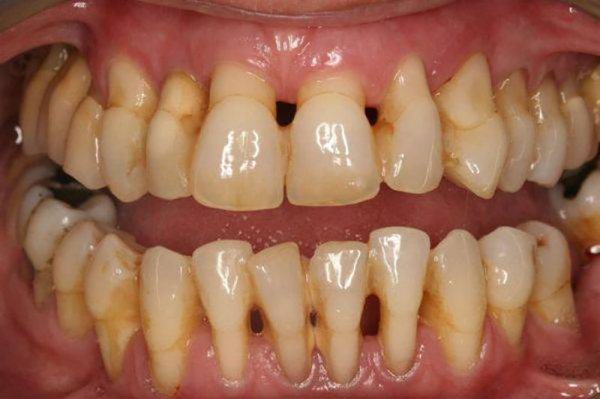Vàng răng là dấu hiệu của bệnh gì? Chẩn đoán và điều trị Vàng răng là dấu hiệu của bệnh gì? Chẩn đoán và điều trị