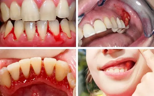 Vàng răng là dấu hiệu của bệnh gì? Chẩn đoán và điều trị Vàng răng là dấu hiệu của bệnh gì? Chẩn đoán và điều trị
