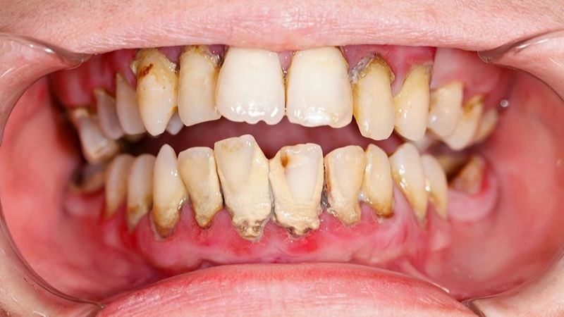 Vàng răng là dấu hiệu của bệnh gì? Chẩn đoán và điều trị Vàng răng là dấu hiệu của bệnh gì? Chẩn đoán và điều trị