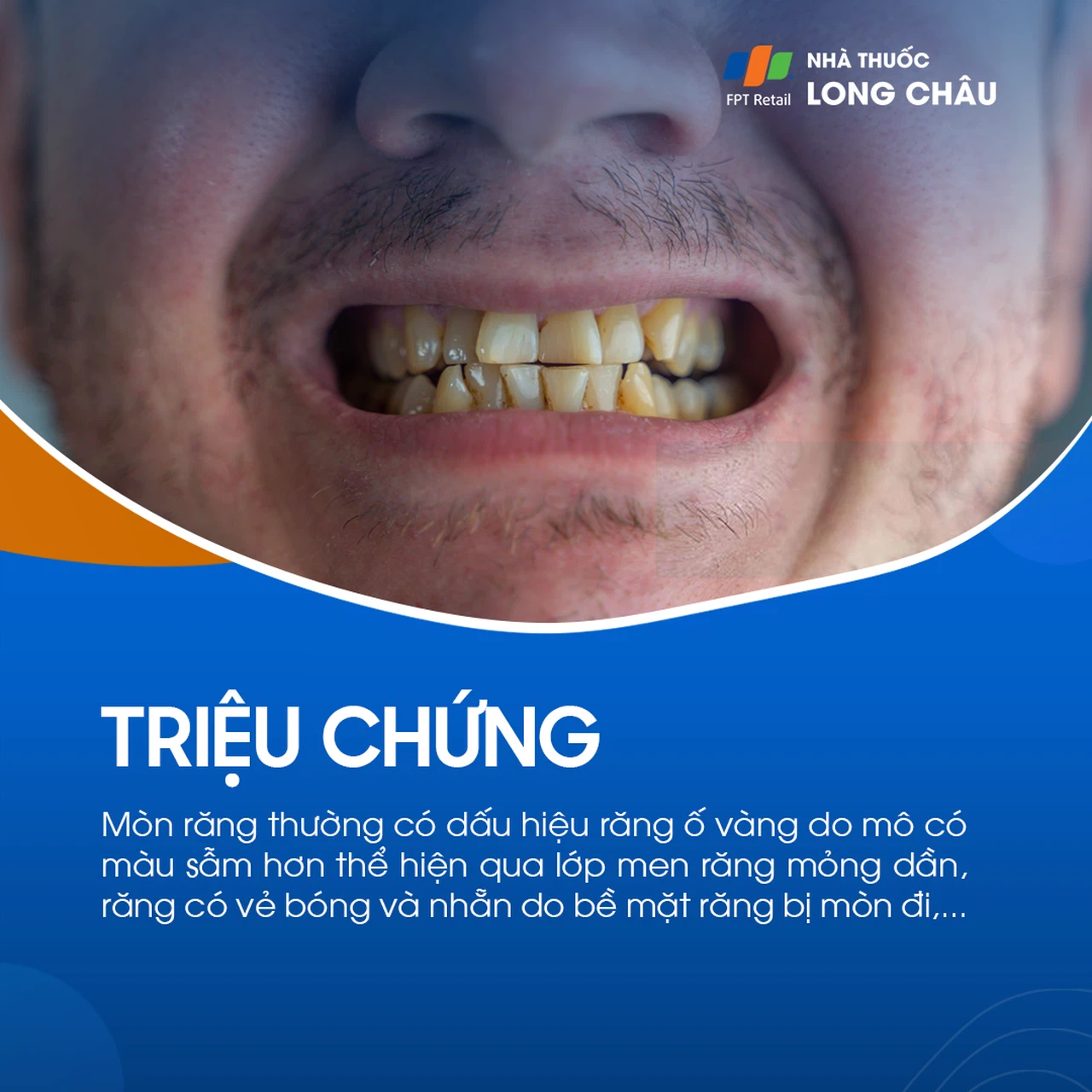 Vàng răng là dấu hiệu của bệnh gì? Chẩn đoán và điều trị Vàng răng là dấu hiệu của bệnh gì? Chẩn đoán và điều trị