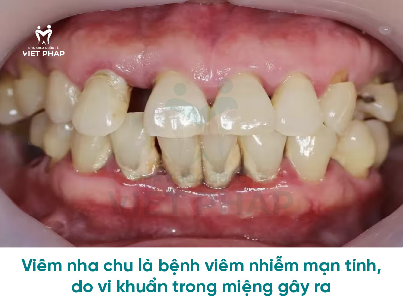 Vàng răng là dấu hiệu của bệnh gì? Chẩn đoán và điều trị Vàng răng là dấu hiệu của bệnh gì? Chẩn đoán và điều trị