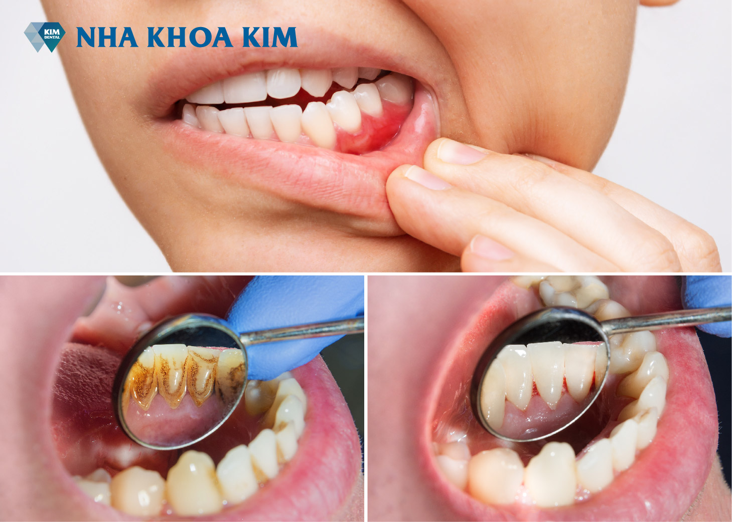 Vàng răng là dấu hiệu của bệnh gì? Chẩn đoán và điều trị Vàng răng là dấu hiệu của bệnh gì? Chẩn đoán và điều trị