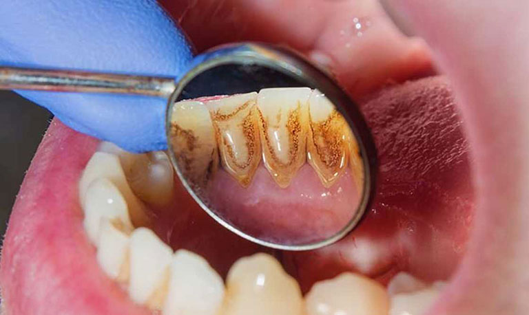 Vàng răng là dấu hiệu của bệnh gì? Chẩn đoán và điều trị Vàng răng là dấu hiệu của bệnh gì? Chẩn đoán và điều trị