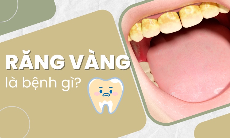 Vàng răng: Nguyên nhân, phân loại và cách khắc phục hiệu quả vang rang nguyen nhan phan loai va cach khac phuc hieu qua 67b2df6d5844f