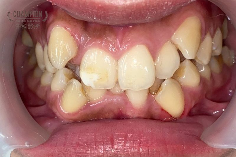 Vàng răng và hôi miệng: Mối liên hệ và cách xử lý toàn diện vang rang va hoi mieng moi lien he va cach xu ly toan dien 67b4260a3d539