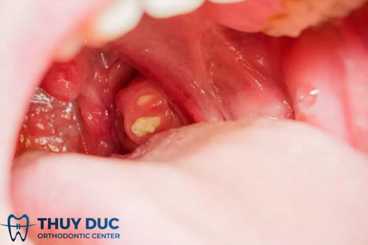 Vàng răng và hôi miệng: Mối liên hệ và cách xử lý toàn diện Vàng răng và hôi miệng: Mối liên hệ và cách xử lý toàn diện