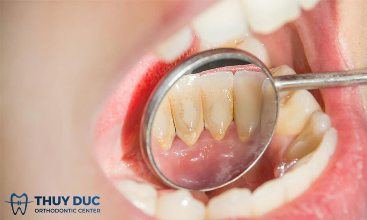 Vàng răng và hôi miệng: Mối liên hệ và cách xử lý toàn diện Vàng răng và hôi miệng: Mối liên hệ và cách xử lý toàn diện