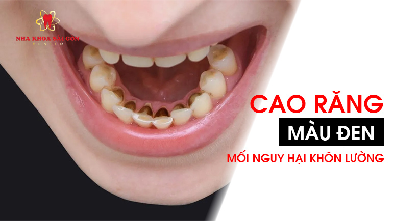 Vàng răng và hôi miệng: Mối liên hệ và cách xử lý toàn diện Vàng răng và hôi miệng: Mối liên hệ và cách xử lý toàn diện