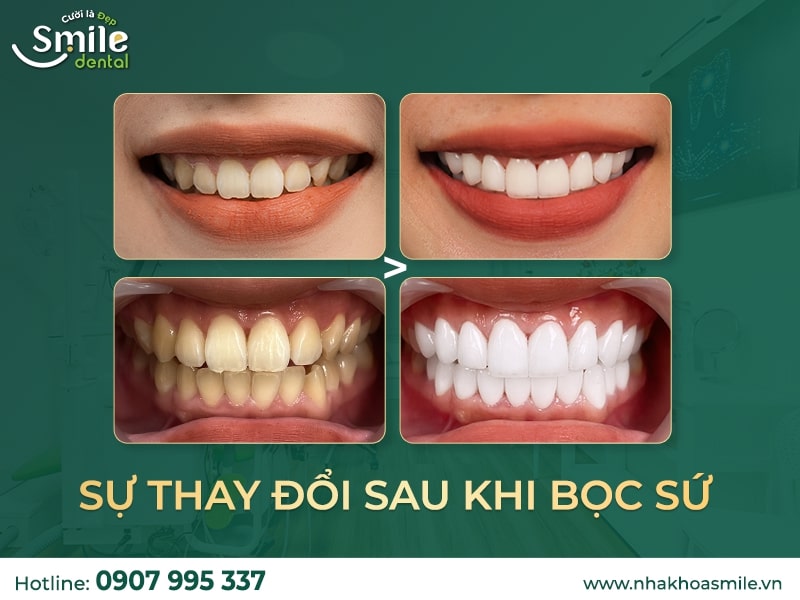 Vàng răng và hôi miệng: Mối liên hệ và cách xử lý toàn diện Vàng răng và hôi miệng: Mối liên hệ và cách xử lý toàn diện