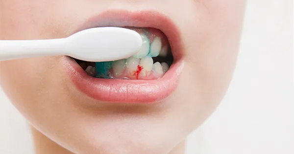 Vàng răng và hôi miệng: Mối liên hệ và cách xử lý toàn diện Vàng răng và hôi miệng: Mối liên hệ và cách xử lý toàn diện