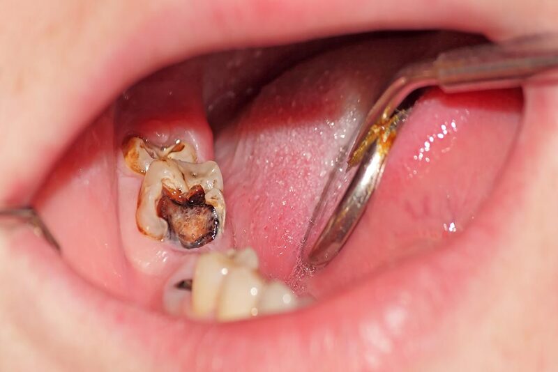 Vàng răng và hôi miệng: Mối liên hệ và cách xử lý toàn diện Vàng răng và hôi miệng: Mối liên hệ và cách xử lý toàn diện