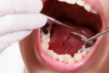 Vàng răng do thói quen uống trà: Ảnh hưởng và lời khuyên nha khoa